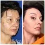 Facelift before and after results at Memorial Ataşehir Hospital, visible facial rejuvenation