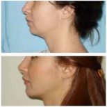 Facelift before and after results at Memorial Ataşehir Hospital, visible jawline improvement