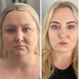 Facelift before and after results at Memorial Ataşehir Hospital – visible facial rejuvenation