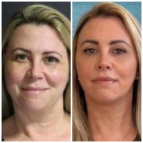 Facelift before and after results at Memorial Ataşehir Hospital, visible facial rejuvenation