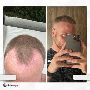 Vorher-nachher-Ergebnis Haartransplantation bei CE International Hospital, Haaransatz wiederhergestellt