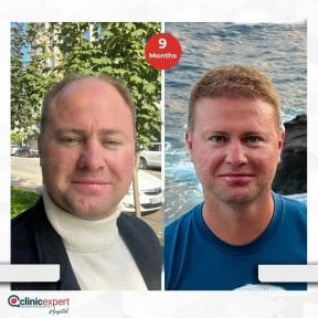 Vorher-nachher-Ergebnis Haartransplantation bei CE International Hospital, 9 Monate