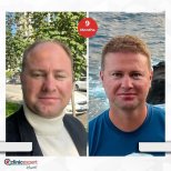 Vorher-nachher-Ergebnis Haartransplantation bei CE International Hospital, 9 Monate