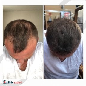 Vorher-nachher-Ergebnis Haartransplantation bei CE International Hospital, volle Haarlinie