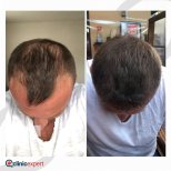 Vorher-nachher-Ergebnis Haartransplantation bei CE International Hospital, volle Haarlinie