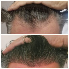 Vorher-nachher-Ergebnisse der Haartransplantation bei CE International Hospital, dichtere Haarlinie