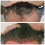 Vorher-nachher-Ergebnisse der Haartransplantation bei CE International Hospital, dichtere Haarlinie