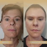 Vorher-nachher-Ergebnis Brauenlifting bei Dr. Safa Manav Clinic, sichtbare Stirnstraffung
