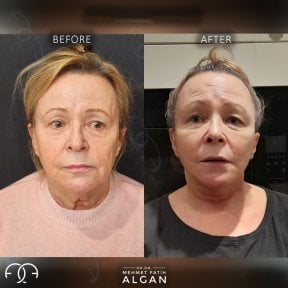 Before and after facial fat transfer results at Dr. Safa Manav Clinic, rejuvenated appearance