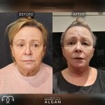 Before and after facial fat transfer results at Dr. Safa Manav Clinic, rejuvenated appearance