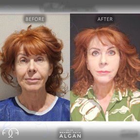 Vorher-nachher-Ergebnis Brauenlifting bei Dr. Safa Manav Clinic, sichtbare Stirnverjüngung