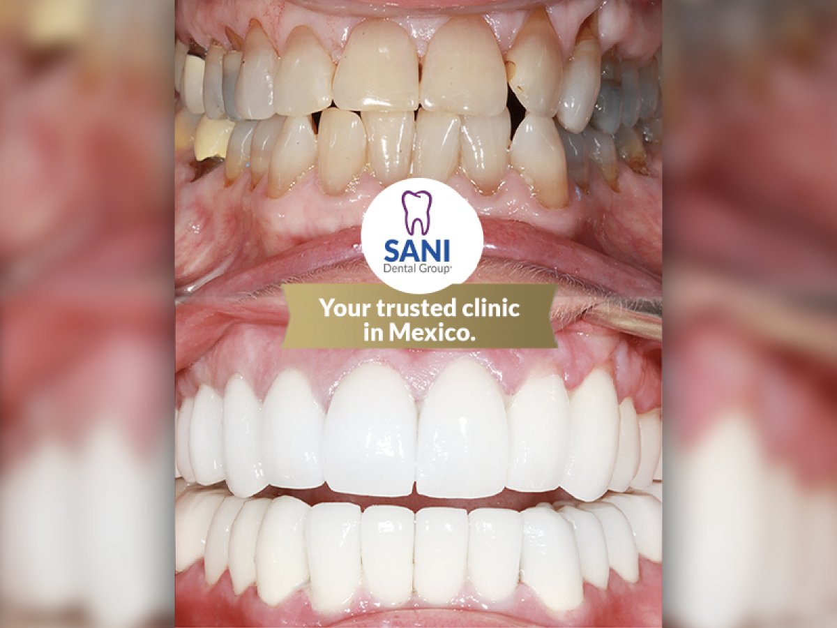 Результаты до и после установки виниров в Sani Dental Group Main Clinic – преображение улыбки