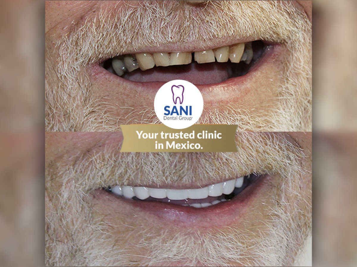 Результат до и после виниров в Sani Dental Group Main Clinic, улучшение улыбки