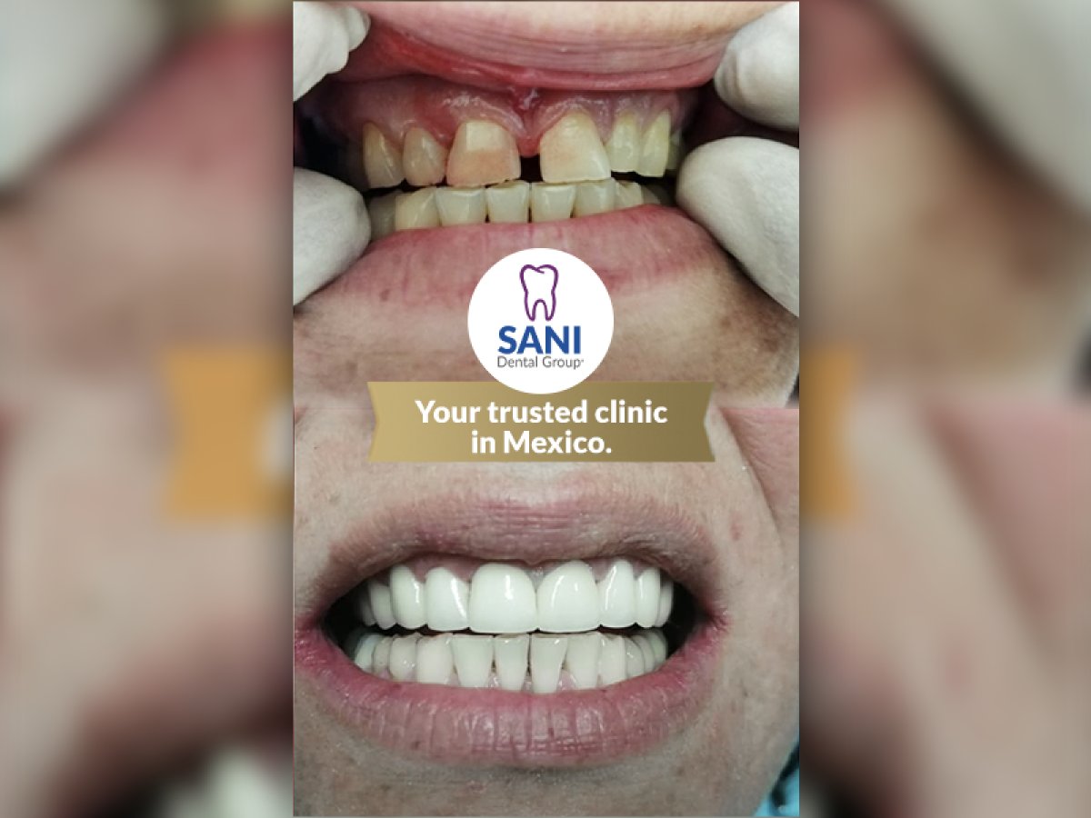 Resultados antes y después de coronas dentales en Sani Dental Group Main Clinic, sonrisa mejorada