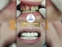 Результати до та після встановлення коронок у Sani Dental Group Main Clinic, покращена посмішка