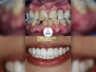 Vorher-nachher Zahnersatz bei Sani Dental Group Main Clinic, Ergebnis Lächeln