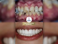 Vorher-nachher Zahnersatz bei Sani Dental Group Main Clinic, Ergebnis Lächeln