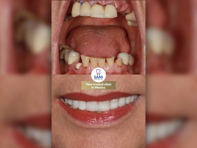 Vorher-nachher-Ergebnis Zahnersatz bei Sani Dental Group Main Clinic, Lächeln wiederhergestellt