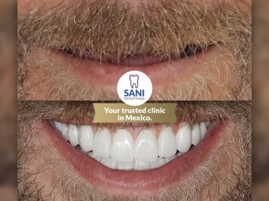Vorher-nachher-Ergebnis Zahnersatz bei Sani Dental Group Main Clinic