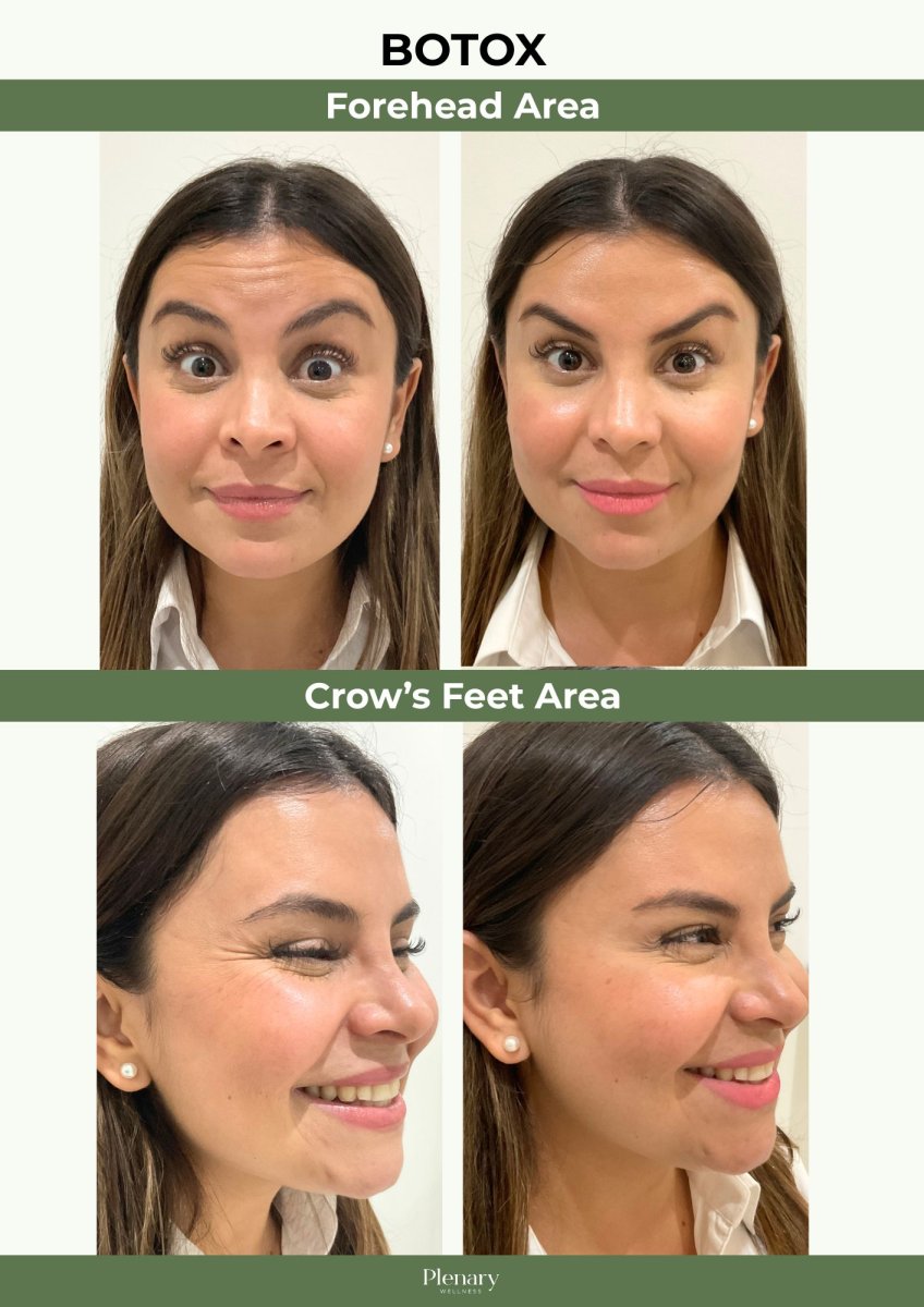 Résultat avant/après injections de Botox chez Plenary Wellness : front et pattes d’oie lissés