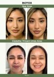 Результати до і після ботоксу для щелепи та міжбрів'я в клініці Plenary Wellness