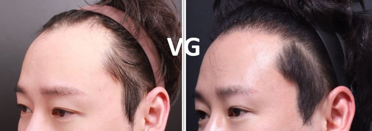 نتيجة زراعة الشعر FUE قبل وبعد في VG Plastic Surgery، خط شعر محسّن للمريض