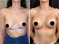 Vorher-nachher-Ergebnisse der Brustimplantat-Revision in der Dr. Safa Manav Klinik