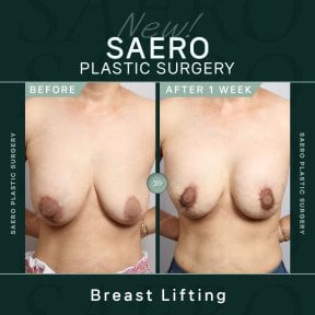 Résultats avant et après lifting mammaire chez SAERO Plastic Surgery, effet visible après 1 semaine