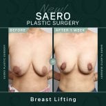 Résultats avant et après lifting mammaire chez SAERO Plastic Surgery, effet visible après 1 semaine