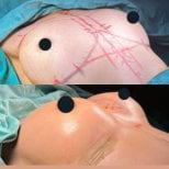 Before and after breast augmentation results at Memorial Bahçelievler Hospital, enhanced shape