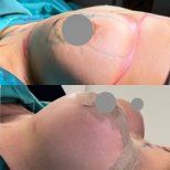 Before and after breast augmentation results at Memorial Bahçelievler Hospital, enhanced shape