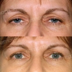 Before and after blepharoplasty results at Memorial Şişli Hospital, eyelid correction surgery