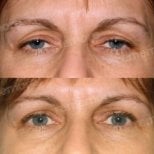 Before and after blepharoplasty results at Memorial Şişli Hospital, eyelid correction surgery