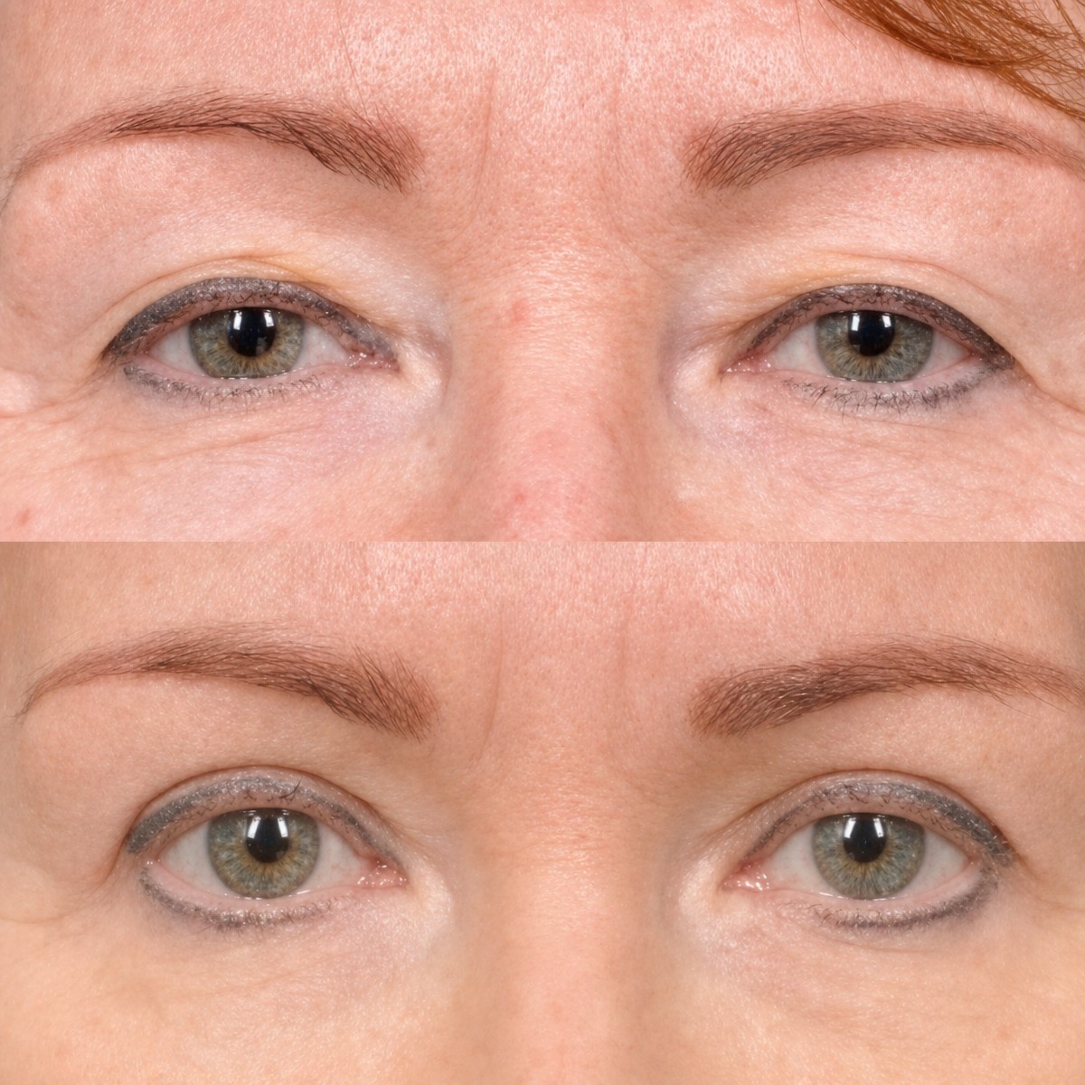 Resultados de blefaroplastia antes y después en Memorial Şişli Hospital, corrección de párpados