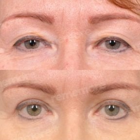 Before and after blepharoplasty results at Memorial Şişli Hospital, eyelid correction outcome