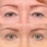 Before and after blepharoplasty results at Memorial Şişli Hospital, eyelid correction outcome