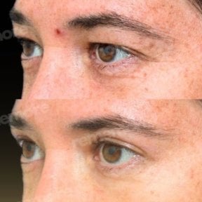 Before and after blepharoplasty results at Memorial Şişli Hospital, eyelid correction outcome