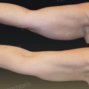 Before and after arm lift results at Memorial Şişli Hospital, improved arm contour visible