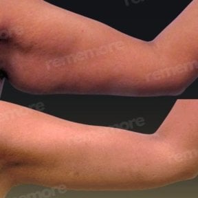 Before and after arm lift results at Memorial Şişli Hospital, improved arm contour after brachioplasty