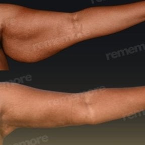 Before and after arm lift (brachioplasty) results at Memorial Şişli Hospital, improved contour