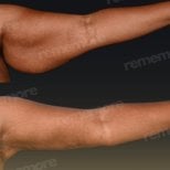 Before and after arm lift (brachioplasty) results at Memorial Şişli Hospital, improved contour