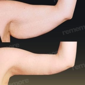 Before and after arm lift (brachioplasty) results at Memorial Şişli Hospital, improved contour