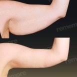 Before and after arm lift (brachioplasty) results at Memorial Şişli Hospital, improved contour