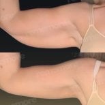 Before and after arm lift results at Memorial Şişli Hospital, improved upper arm contour