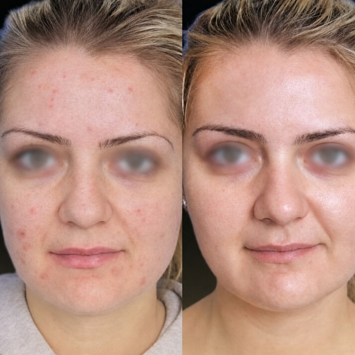 Resultados antes y después de peeling químico en Memorial Bahçelievler Hospital, piel mejorada