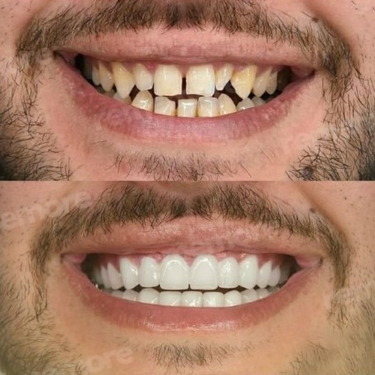Resultados antes y después de dentadura en Memorial Bahçelievler Hospital, sonrisa mejorada