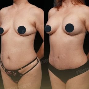 Before and after tummy tuck results at Memorial Bahçelievler Hospital, improved abdomen contour