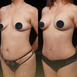 Before and after tummy tuck results at Memorial Bahçelievler Hospital, improved abdomen contour