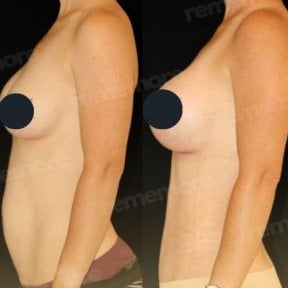 Resultados de abdominoplastia antes y después en Memorial Bahçelievler Hospital, abdomen mejorado