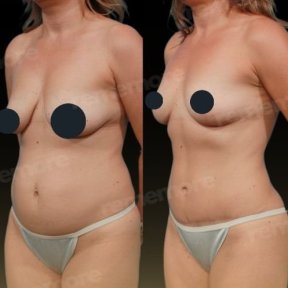Resultados de abdominoplastia antes y después en Memorial Bahçelievler Hospital, abdomen definido